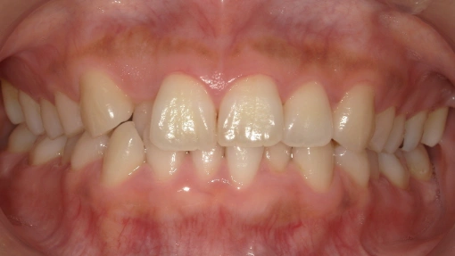 和光市　歯医者　和光市デンタルオフィス　インビザラインの症例2 治療前