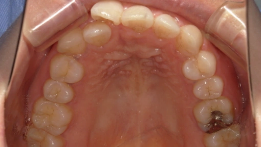 和光市　歯医者　和光市デンタルオフィス　インビザラインの症例3 治療前