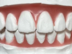 和光市　歯医者　和光市デンタルオフィス　セットアップ模型/仮歯でのイメージのすり合わせ