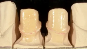 和光市　歯医者　和光市デンタルオフィス　歯の形成
