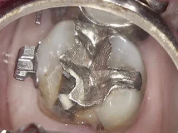 和光市　歯医者　和光市デンタルオフィス　銀歯の内部に再発した虫歯の写真1