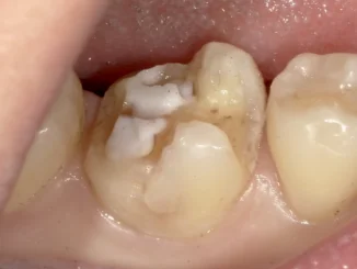 和光市　歯医者　和光市デンタルオフィス　セラミックの症例2 治療前