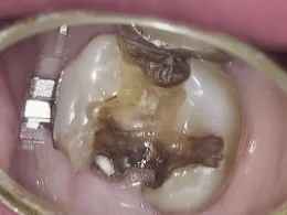和光市　歯医者　和光市デンタルオフィス　銀歯の内部に再発した虫歯の写真2