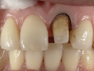 和光市　歯医者　和光市デンタルオフィス　セラミックの症例3 治療中