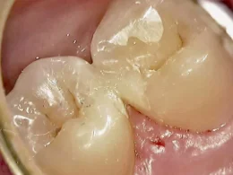 和光市　歯医者　和光市デンタルオフィス　プラスチックの下に再発した虫歯の写真1