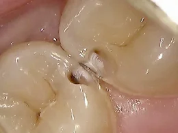 和光市　歯医者　和光市デンタルオフィス　プラスチックの下に再発した虫歯の写真2