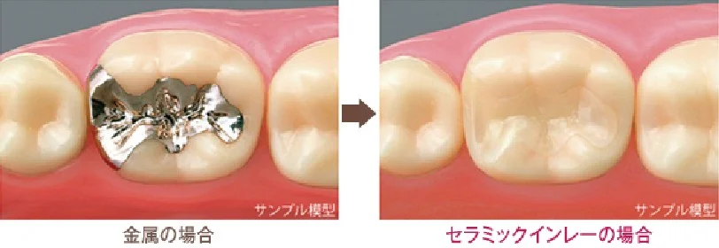 金属とセラミックインレーの比較