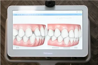 iTero口腔内スキャナー