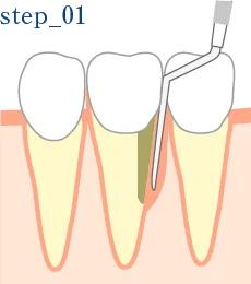 和光市　歯医者　和光市デンタルオフィス　STEP.1 歯周ポケットの測定