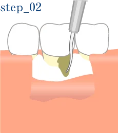 和光市　歯医者　和光市デンタルオフィス　STEP.2 感染部分の洗浄