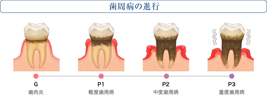 和光市　歯医者　和光市デンタルオフィス　歯周病の進行度(G・P1〜P3)