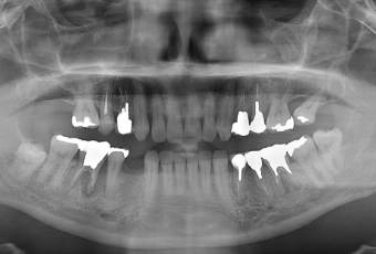 和光市　歯医者　和光市デンタルオフィス　歯のレントゲン写真