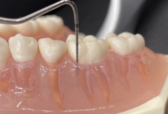 和光市　歯医者　和光市デンタルオフィス　歯周ポケット測定(PPD)イメージ