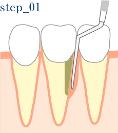 STEP.1 歯周ポケットの測定