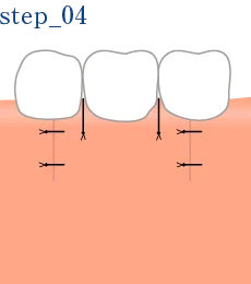 STEP.4 切開した箇所を縫合