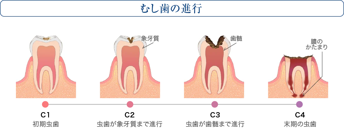虫歯の進行度(C1〜C4)