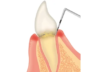 歯周ポケット測定(PPD)イメージ