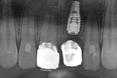 和光市　歯医者　和光市デンタルオフィス　前歯部審美症例 治療後