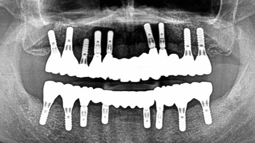 和光市　歯医者　和光市デンタルオフィス　多数歯欠損症例 治療前