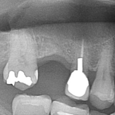 和光市　歯医者　和光市デンタルオフィス　サイナスリフトを行い、同時にインプラントを埋入したケース