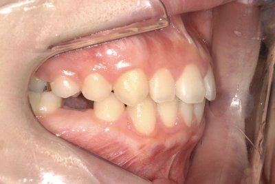 和光市　歯医者　和光市デンタルオフィス　乳歯(永久歯欠損)症例 治療前