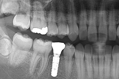 和光市　歯医者　和光市デンタルオフィス　乳歯(永久歯欠損)症例 治療後