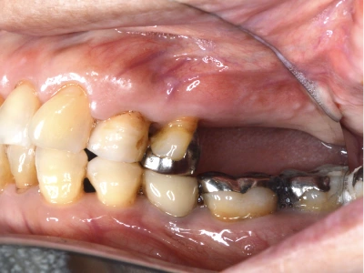 和光市　歯医者　和光市デンタルオフィス　臼歯部症例 治療前