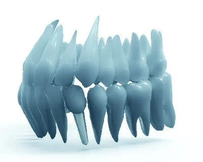 天然歯とほとんど変わらないインプラント治療