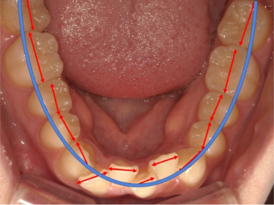 和光市　歯医者　和光市デンタルオフィス　アーチディスクレパンシー(=歯槽骨基底骨周径-歯冠近遠心径の総和)