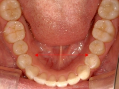 和光市　歯医者　和光市デンタルオフィス　側方拡大治療後