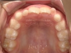 和光市　歯医者　和光市デンタルオフィス　顎骨拡大(口蓋縫合離開)装置治療前