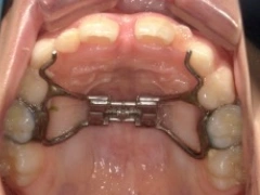 和光市　歯医者　和光市デンタルオフィス　顎骨拡大(口蓋縫合離開)装置治療後