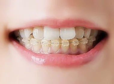 ワイヤー矯正治療のイメージ