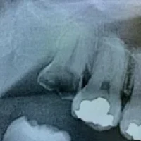 和光市　歯医者　和光市デンタルオフィス　虫歯で歯髄炎が発生