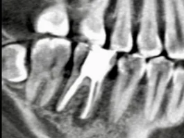 和光市　歯医者　和光市デンタルオフィス　マイクロエンドの症例2 写真3