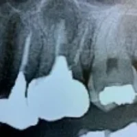 和光市　歯医者　和光市デンタルオフィス　歯根嚢胞へ発展