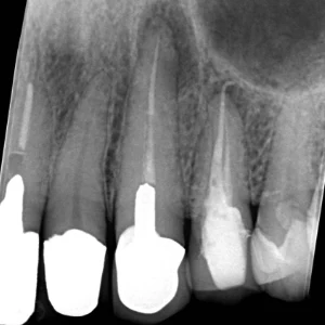 和光市　歯医者　和光市デンタルオフィス　難症例の再治療実績1 治療前