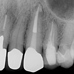 和光市　歯医者　和光市デンタルオフィス　難症例の再治療実績1 治療後