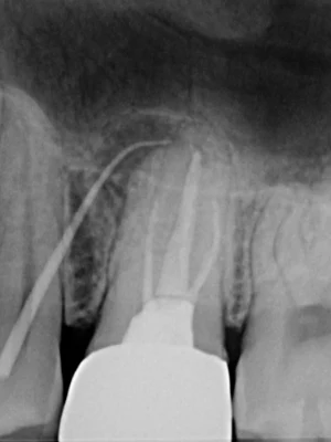 和光市　歯医者　和光市デンタルオフィス　難症例の再治療実績2 治療前
