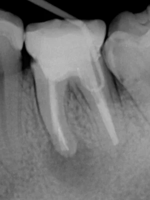 和光市　歯医者　和光市デンタルオフィス　難症例の再治療実績3 治療前