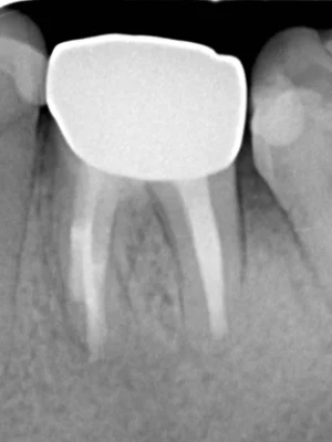 和光市　歯医者　和光市デンタルオフィス　難症例の再治療実績3 治療後
