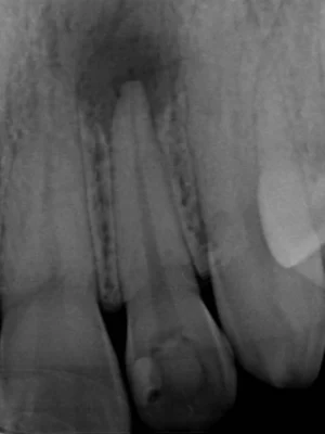 和光市　歯医者　和光市デンタルオフィス　難症例の再治療実績5 治療前