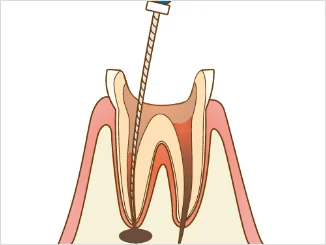 和光市　歯医者　和光市デンタルオフィス　根管内に器具を挿入して感染歯質を除去し、清掃と消毒を行います。