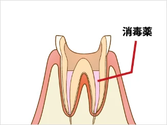 和光市　歯医者　和光市デンタルオフィス　症状が軽減するまで清掃と消毒を数回にわたり繰り返します。