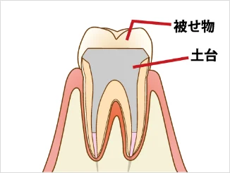和光市　歯医者　和光市デンタルオフィス　消毒が完了したら、土台と被せ物で再感染を予防します。