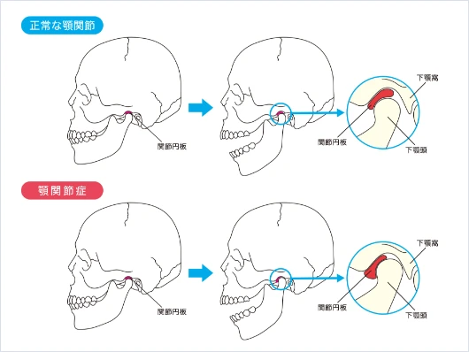 和光市　歯医者　和光市デンタルオフィス　正常な顎関節と顎関節症の比較