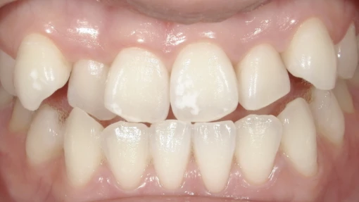 和光市　歯医者　和光市デンタルオフィス　ホワイトニングの症例 ポリリン3回コース 治療後