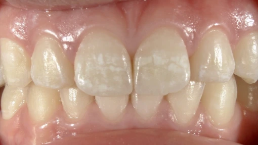 和光市　歯医者　和光市デンタルオフィス　アイコンの症例 前歯2本 治療前
