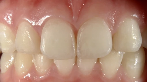 和光市　歯医者　和光市デンタルオフィス　アイコンの症例 前歯2本 治療後