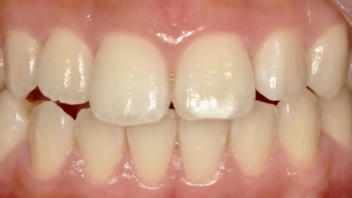 和光市　歯医者　和光市デンタルオフィス　アイコンの症例 前歯1本 治療前